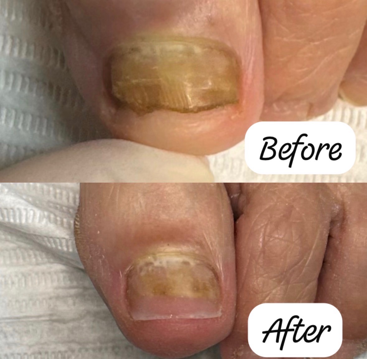 Before and after care on a thickened, discolored big toenail, reduced and with the sidewalls cleared
