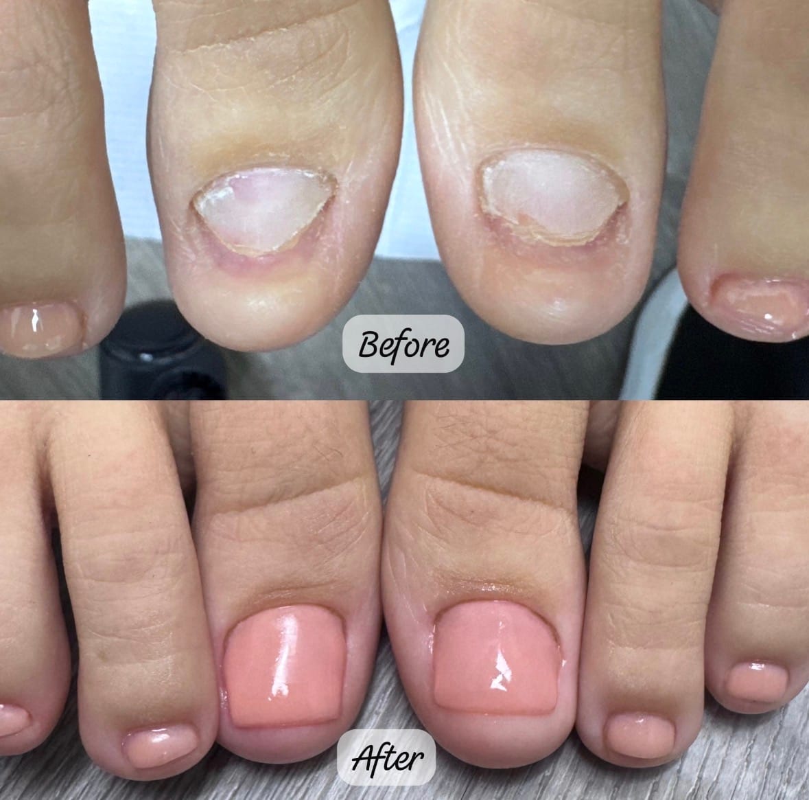 Before and after toenail reconstruction on two toes, with the nail plates rebuilt and finished in a soft pink
